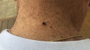 Tick Season: Expert explains what you need to know to before heading out